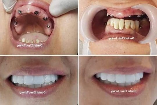 Facette Dentaire en Turquie : Une Solution Esthétique à Découvrir
